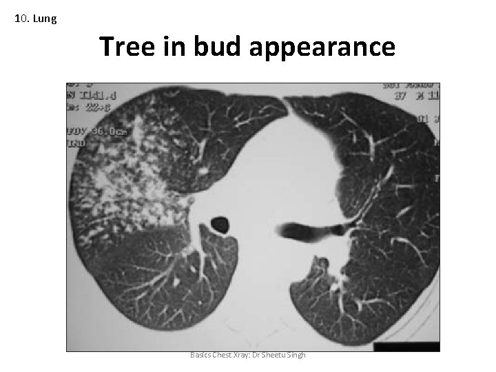 10. Lung Tree in bud appearance Basics Chest Xray: Dr Sheetu Singh 