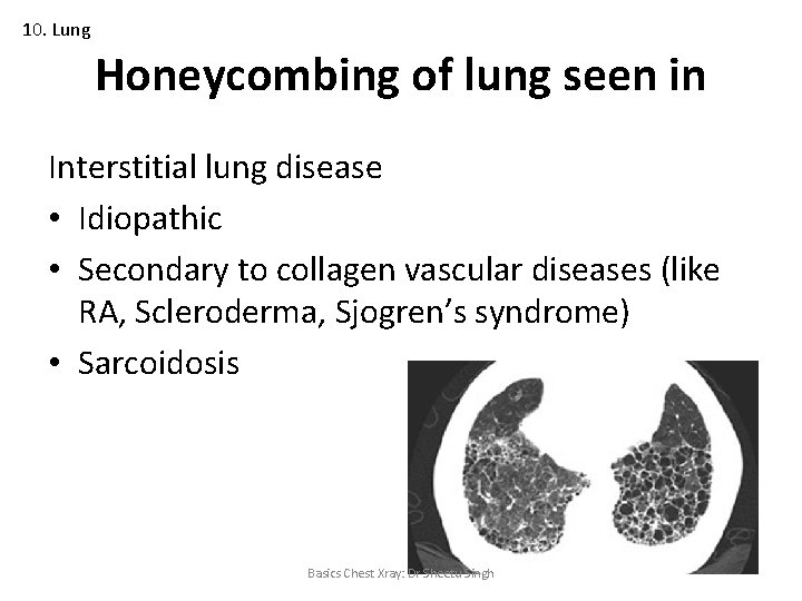 10. Lung Honeycombing of lung seen in Interstitial lung disease • Idiopathic • Secondary