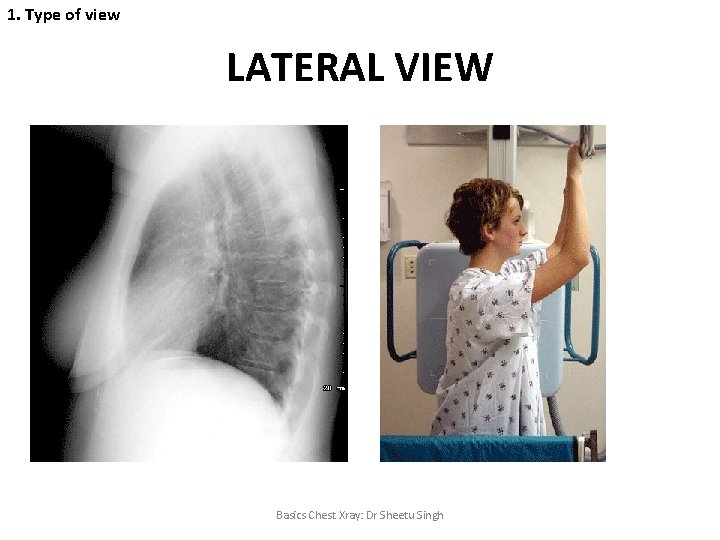 1. Type of view LATERAL VIEW Basics Chest Xray: Dr Sheetu Singh 
