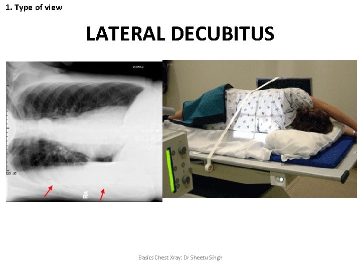1. Type of view LATERAL DECUBITUS Basics Chest Xray: Dr Sheetu Singh 