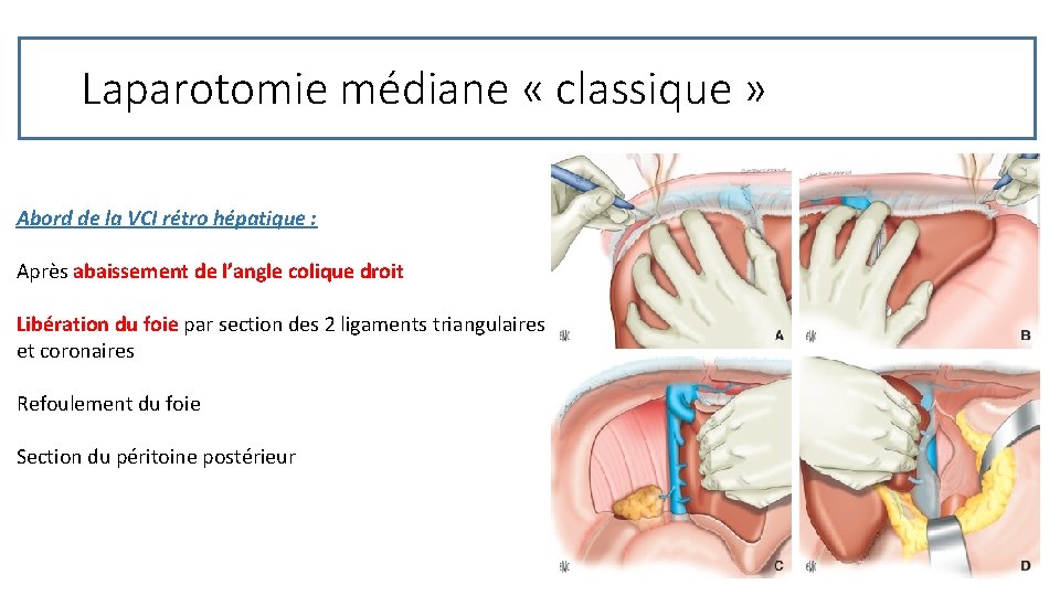 Laparotomie médiane « classique » Abord de la VCI rétro hépatique : Après abaissement