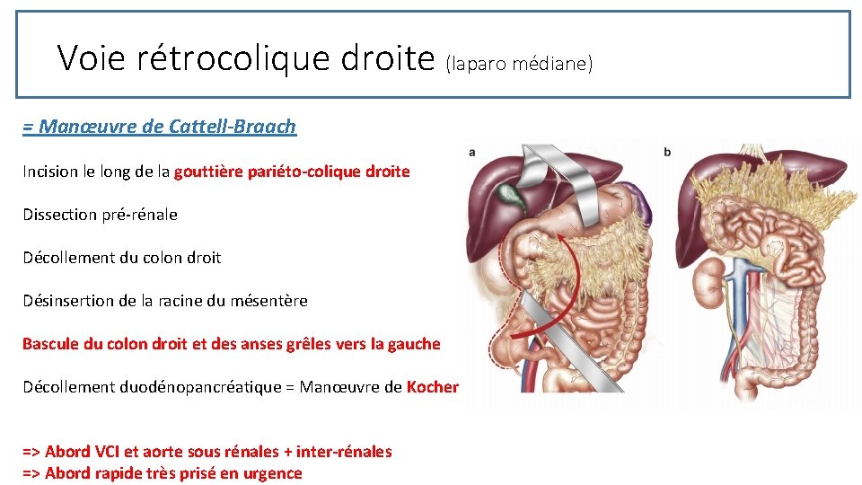 Voie rétrocolique droite (laparo médiane) = Manœuvre de Cattell-Braach Incision le long de la