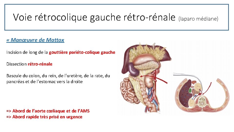 Voie rétrocolique gauche rétro-rénale (laparo médiane) = Manœuvre de Mattox Incision de long de