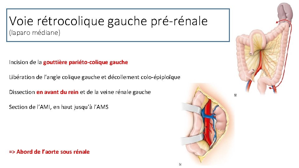 Voie rétrocolique gauche pré-rénale (laparo médiane) Incision de la gouttière pariéto-colique gauche Libération de