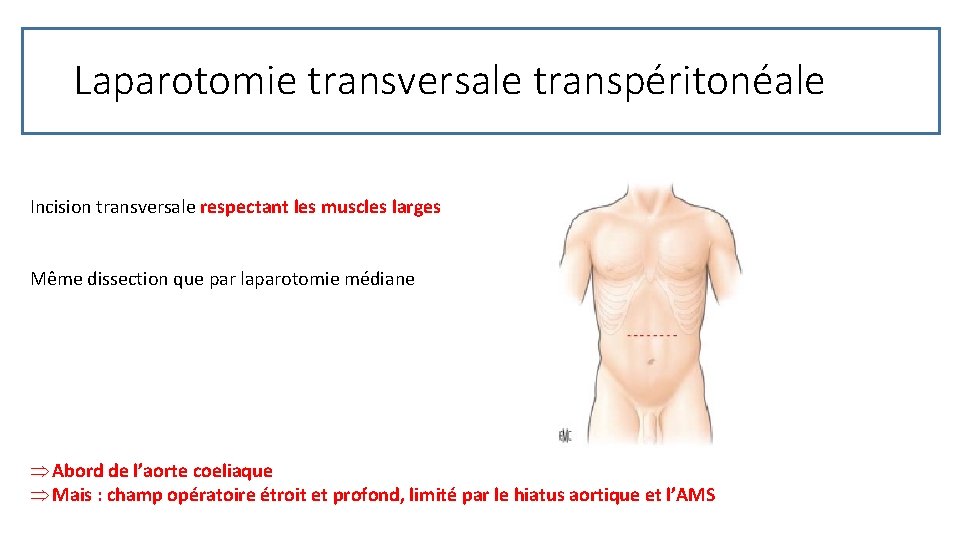 Laparotomie transversale transpéritonéale Incision transversale respectant les muscles larges Même dissection que par laparotomie