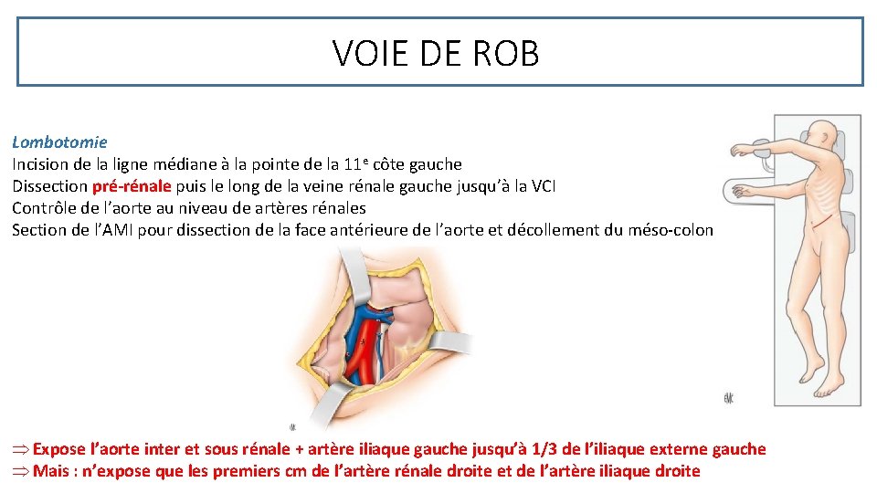 VOIE DE ROB Lombotomie Incision de la ligne médiane à la pointe de la