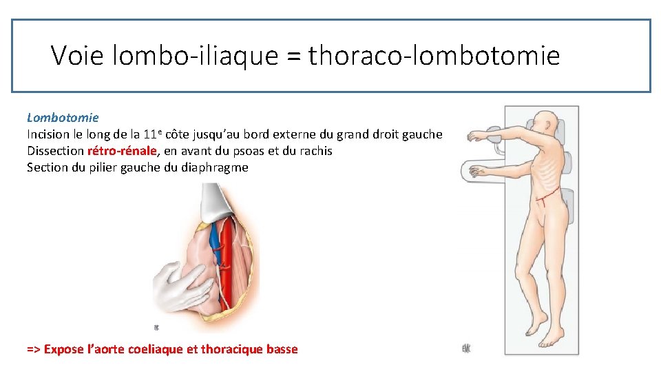 Voie lombo-iliaque = thoraco-lombotomie Lombotomie Incision le long de la 11 e côte jusqu’au