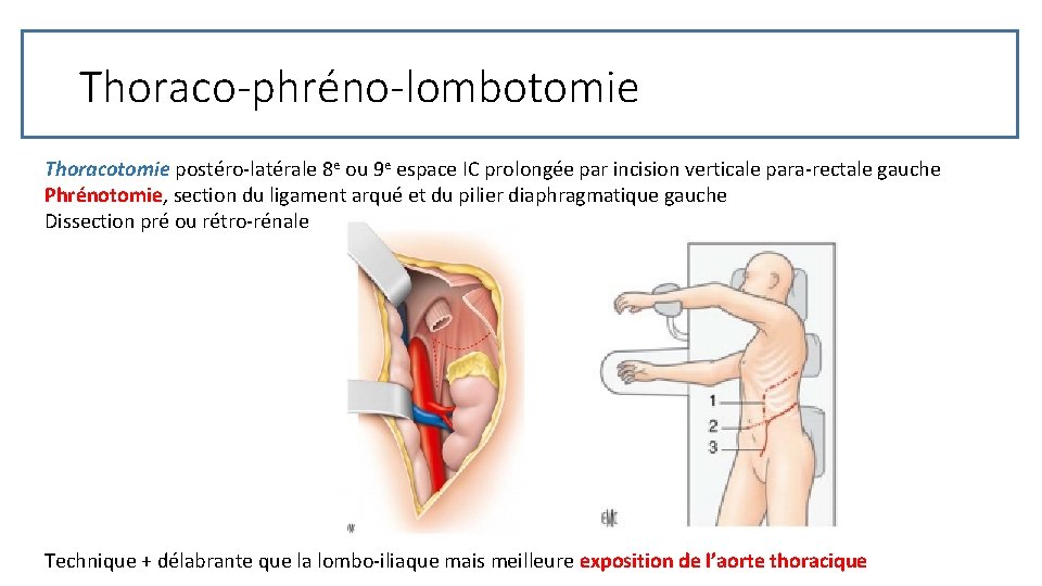 Thoraco-phréno-lombotomie Thoracotomie postéro-latérale 8 e ou 9 e espace IC prolongée par incision verticale