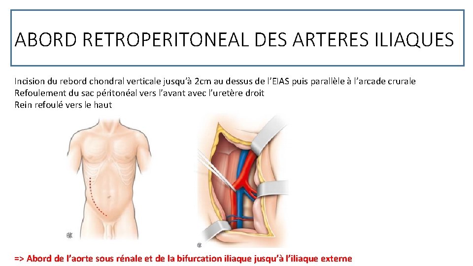 ABORD RETROPERITONEAL DES ARTERES ILIAQUES Incision du rebord chondral verticale jusqu’à 2 cm au