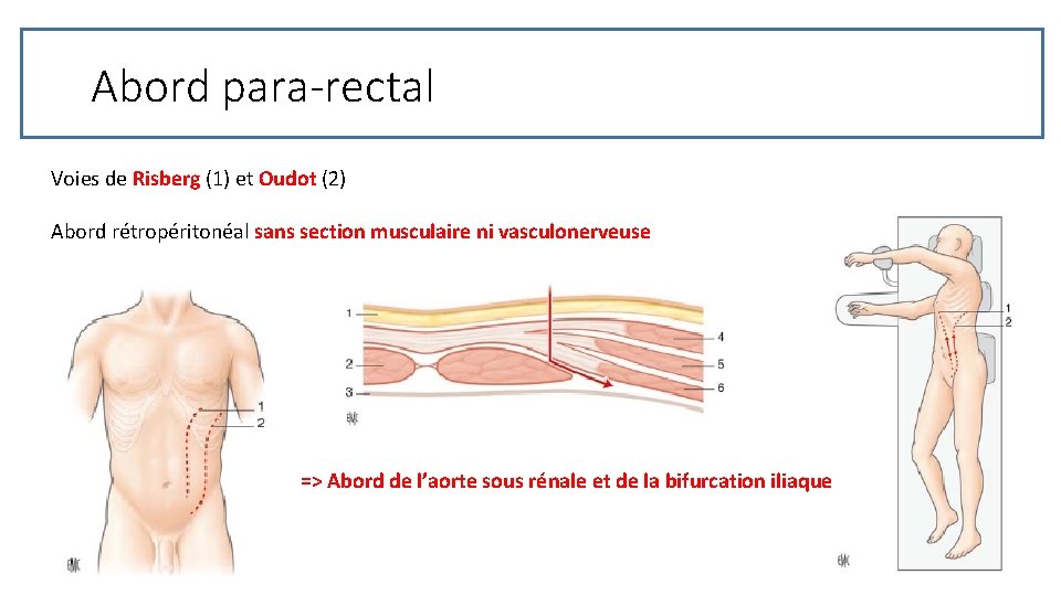 Abord para-rectal Voies de Risberg (1) et Oudot (2) Abord rétropéritonéal sans section musculaire