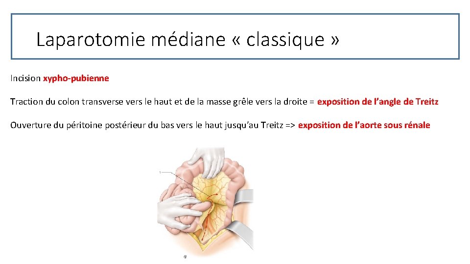 Laparotomie médiane « classique » Incision xypho-pubienne Traction du colon transverse vers le haut
