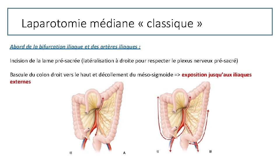 Laparotomie médiane « classique » Abord de la bifurcation iliaque et des artères iliaques