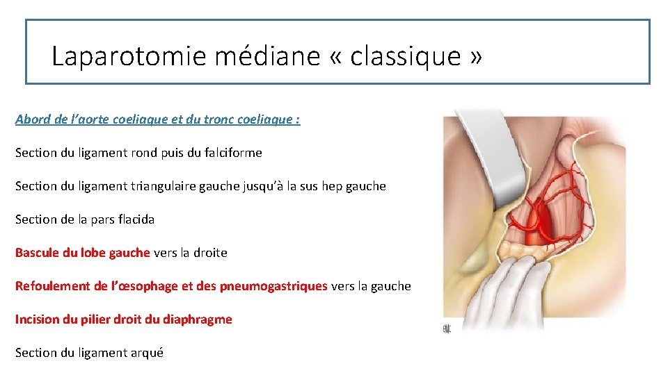 Laparotomie médiane « classique » Abord de l’aorte coeliaque et du tronc coeliaque :