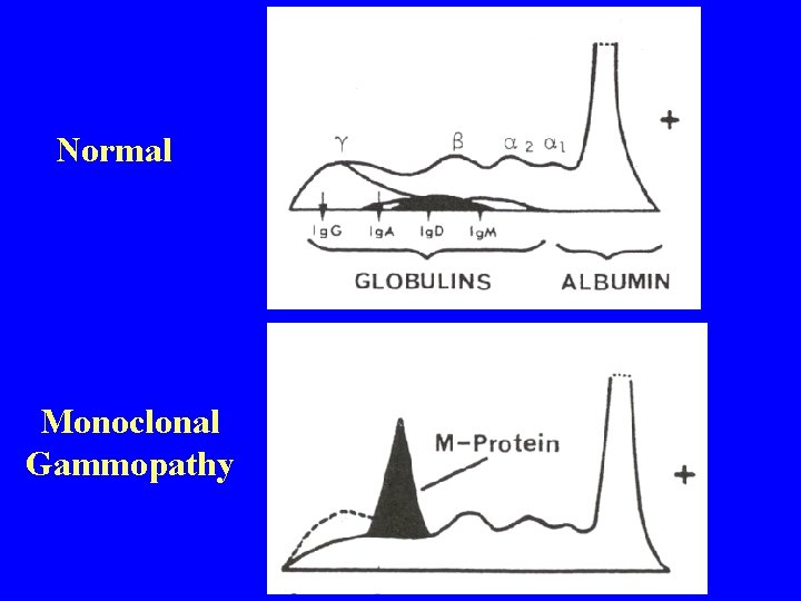 Normal Monoclonal Gammopathy 
