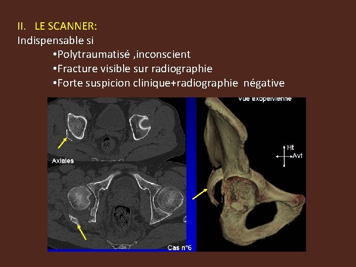 II. LE SCANNER: Indispensable si • Polytraumatisé , inconscient • Fracture visible sur radiographie