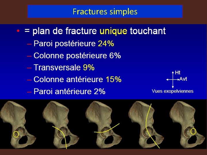 Fractures simples 