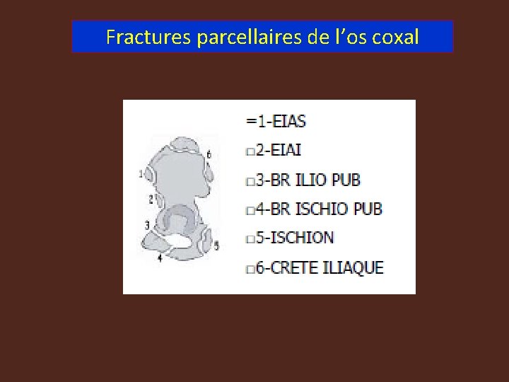 Fractures parcellaires de l’os coxal 