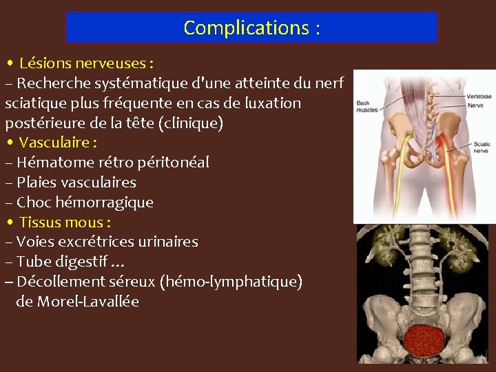 Complications : • Lésions nerveuses : – Recherche systématique d'une atteinte du nerf sciatique