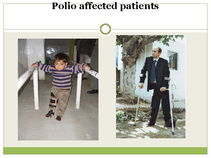Polio affected patients 