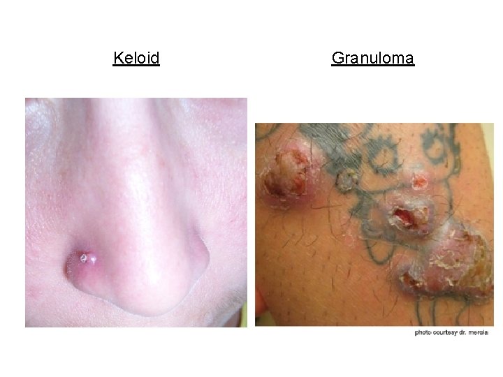 Keloid Granuloma 