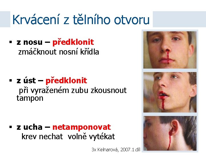 Krvácení z tělního otvoru z nosu – předklonit zmáčknout nosní křídla z úst –