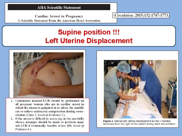 Supine position !!! Left Uterine Displacement 