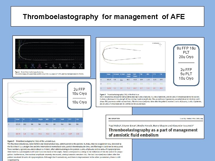 Thromboelastography for management of AFE 8 u FFP 16 u PLT 20 u Cryo