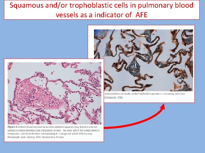 Squamous and/or trophoblastic cells in pulmonary blood vessels as a indicator of AFE 