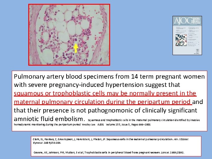 Pulmonary artery blood specimens from 14 term pregnant women with severe pregnancy-induced hypertension suggest