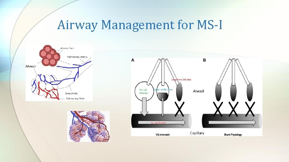 Airway Management for MS-I 