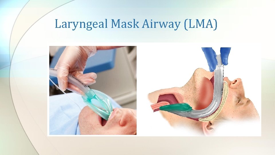 Laryngeal Mask Airway (LMA) 