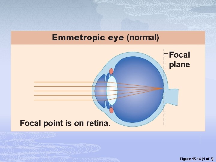 Emmetropic eye (normal) Focal plane Focal point is on retina. Figure 15. 14 (1