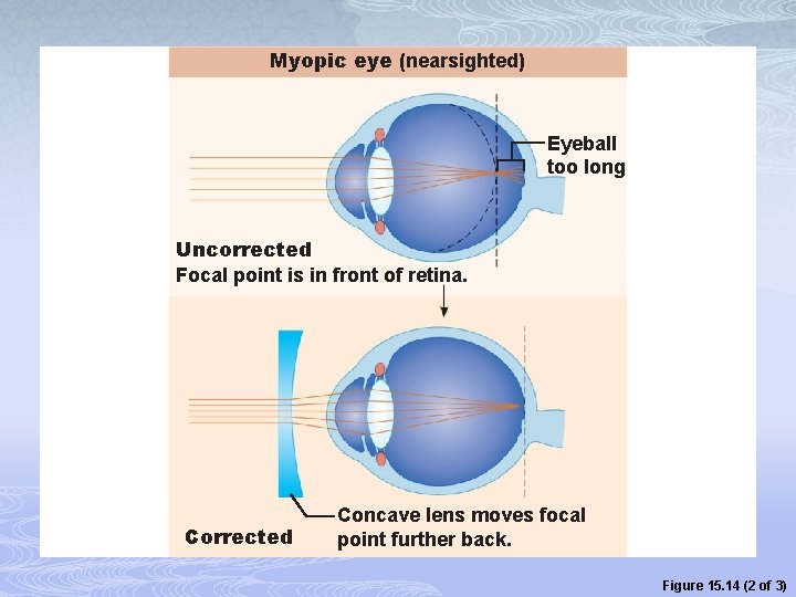 Myopic eye (nearsighted) Eyeball too long Uncorrected Focal point is in front of retina.