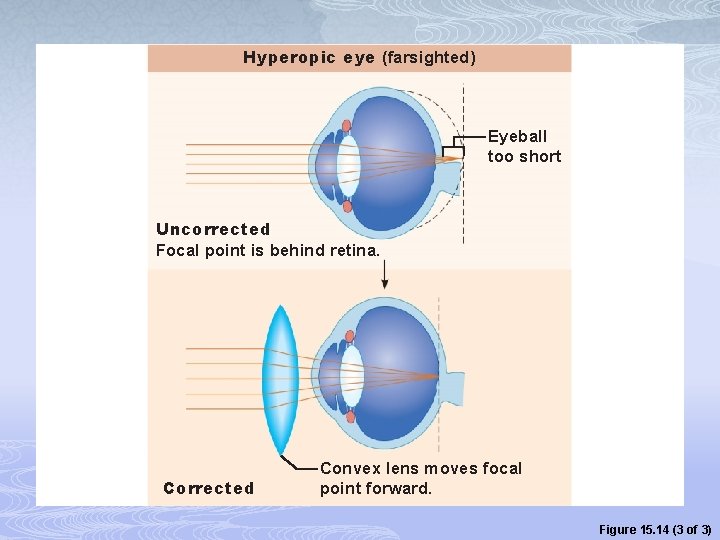 Hyperopic eye (farsighted) Eyeball too short Uncorrected Focal point is behind retina. Corrected Convex