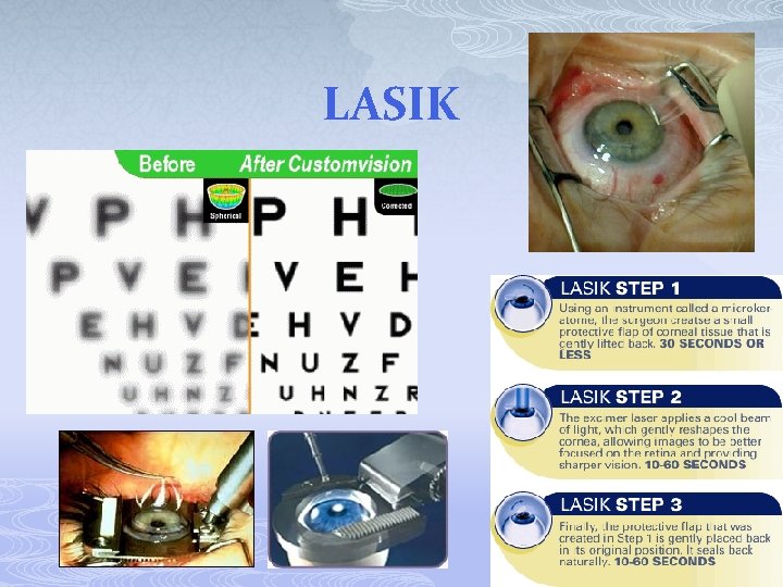 LASIK 