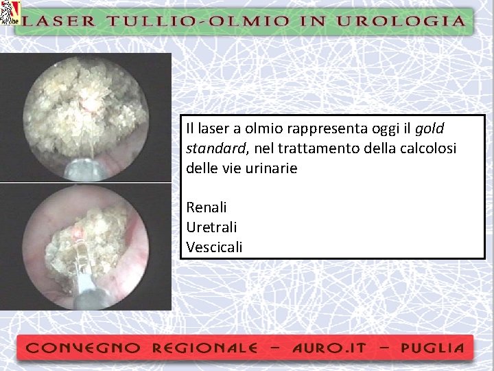 Il laser a olmio rappresenta oggi il gold standard, nel trattamento della calcolosi delle