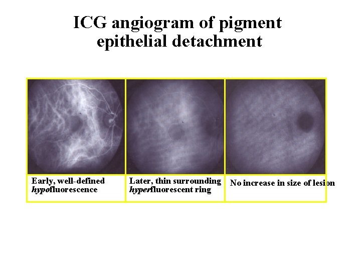 ICG angiogram of pigment epithelial detachment Early, well-defined hypofluorescence Later, thin surrounding No increase