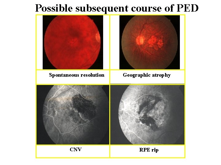 Possible subsequent course of PED Spontaneous resolution CNV Geographic atrophy RPE rip 