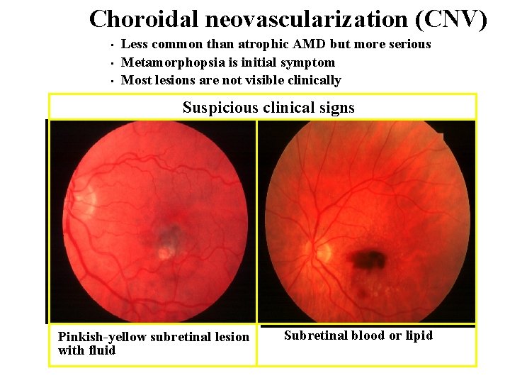 Choroidal neovascularization (CNV) • • • Less common than atrophic AMD but more serious