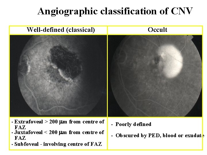 Angiographic classification of CNV Well-defined (classical) Extrafoveal > 200 m from centre of FAZ