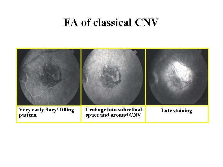 FA of classical CNV Very early ‘lacy’ filling pattern Leakage into subretinal space and