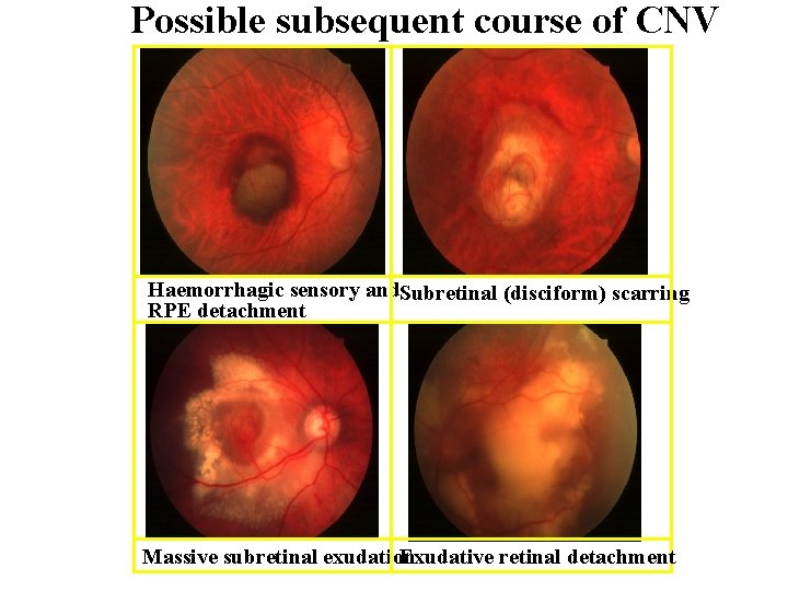 Possible subsequent course of CNV Haemorrhagic sensory and. Subretinal (disciform) scarring RPE detachment Massive