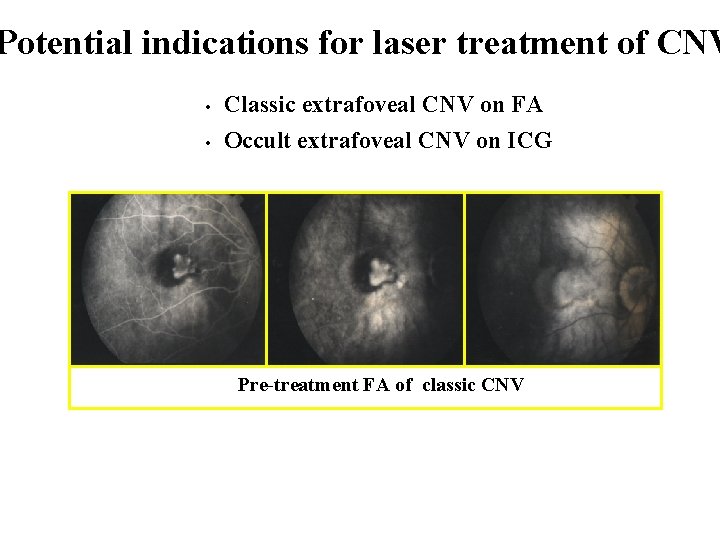 Potential indications for laser treatment of CNV • Classic extrafoveal CNV on FA •
