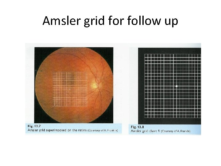 Amsler grid for follow up 