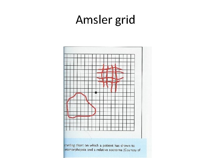 Amsler grid 