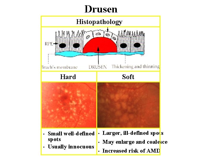 Drusen Histopathology Hard • • Small well-defined spots Usually innocuous Soft • • •