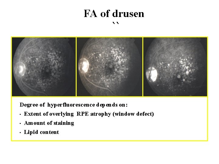 FA of drusen `` Degree of hyperfluorescence depends on: • Extent of overlying RPE