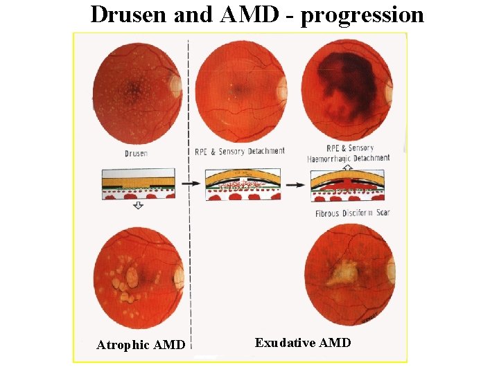 Drusen and AMD - progression Atrophic AMD Exudative AMD 