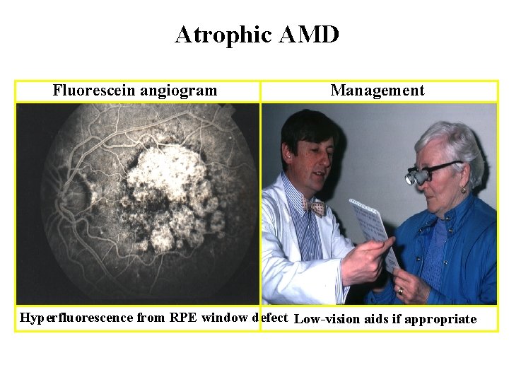 Atrophic AMD Fluorescein angiogram Management Hyperfluorescence from RPE window defect Low-vision aids if appropriate