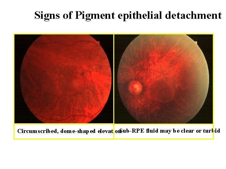 Signs of Pigment epithelial detachment Circumscribed, dome-shaped elevation. Sub-RPE fluid may be clear or